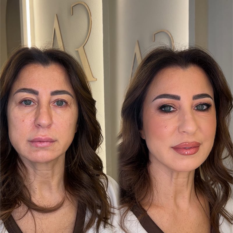 Risultato trattamento